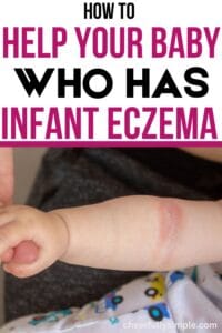 how to help your baby who has infant eczema Pinterest pin