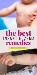 the best infant eczema remedies Pinterest pin