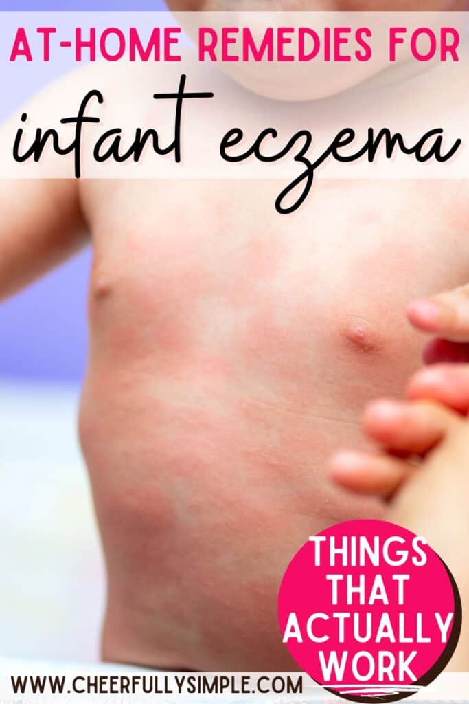 at-home remedies for infant eczema Pinterest pin