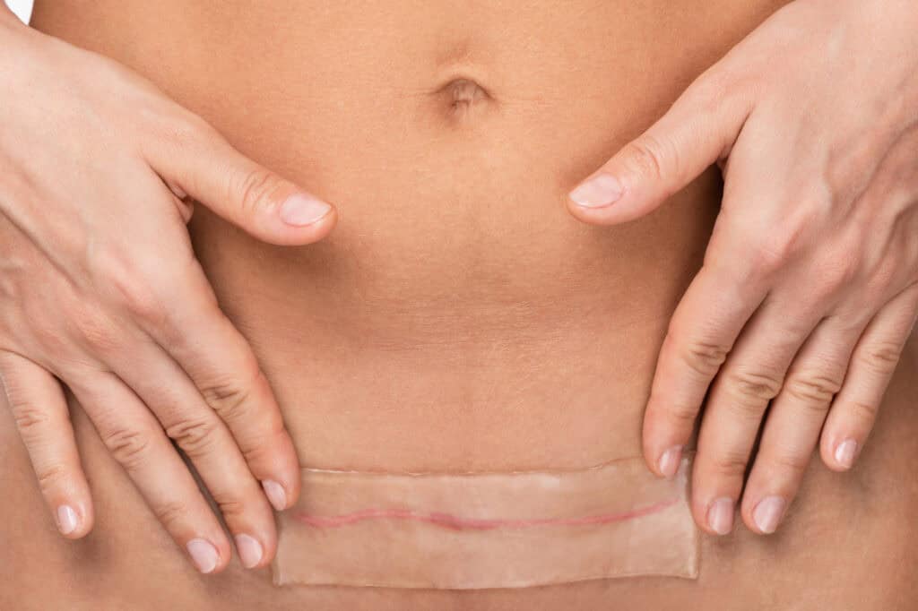 woman with her hands around her C-section scar during C-section recovery